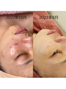 レイネイル レイエステティック 岐阜茜部店(RAY NAIL & RAY ESTHETIC)/マイクロニードルピーリング
