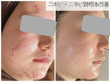 おうちサロン ミキの雰囲気（漢方ハーブピーリングや、選べる組合せピーリングで本気の肌改善）
