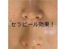 ポリー(Polly)の雰囲気（ララピールが進化！美肌乳酸菌プラスされたセラピール&LDM¥9900）