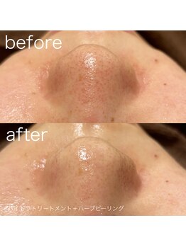 ルルラ リコ(lulula rico)/症例写真/ハイドラ毛穴洗浄