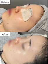 リアン(Lien)/【毛穴洗浄×美容液導入】