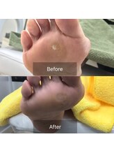 ドクターネイル爪革命 北千住店/たこ、魚の目ケア　足湯あり