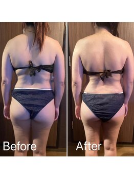 リコ 白金台(Liko)/ビフォーアフター【背中1回】