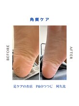 ピーアンドオー(P&O)/角質ケア