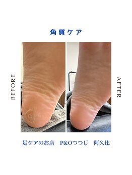 ピーアンドオー(P&O)/角質ケア