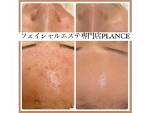 プランス 渋谷(PLANCE)/毛穴/ハーブ/ニキビケア