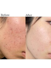 ラナ(Lana)/ラピエラピーリング