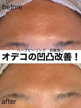 ヴィオール 名古屋栄店(VIOR)/《肌質改善》　ハーブピーリング