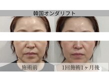 脂肪にアプローチし自然なハリと立体感のある小顔印象へ