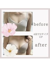 アリサナ(Arisana)/症例写真　バスト　葛西