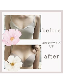 アリサナ(Arisana)/症例写真　バスト　葛西