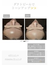 シュシュ(chouchou)/ララピール進化版！ダクトピール