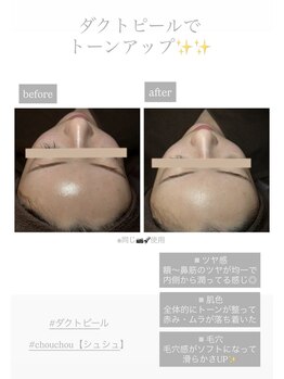 シュシュ(chouchou)/ララピール進化版!ダクトピール