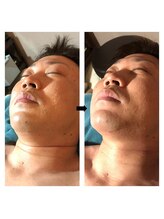 伊達男/フォースカッター 事例（小顔）