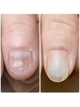 スマイルニコ(smile nico)/2ヶ月でこの違い