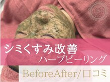 ベアール(beal)/シミくすみにハーブピーリング