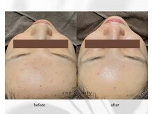 アン ビューティー(ann beauty)/施術2回【症例写真】30代