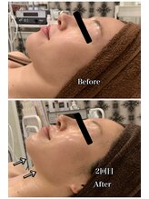 ブランシュール/小顔タイト×エンビロン