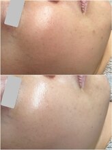 ティアーナ(Tiaana)/ララピール３週間後