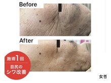 リミュール(Ri.miyuru)/エクソソーム導入