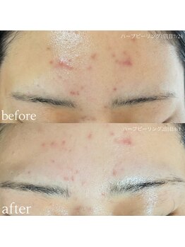 ダオン(Daon)/ハーブピーリング