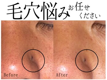 スポット 薬院駅前店(SPOT)/男女の毛穴肌悩みお任せください