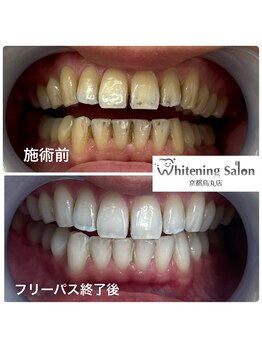 ホワイトニングサロン 京都烏丸店/ホワイトニング施術例