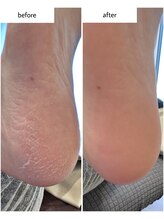 ケアプラス(care plus)/足裏角質ケア