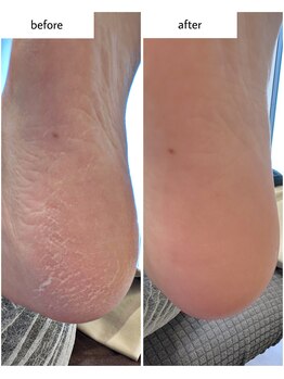 ケアプラス(care plus)/足裏角質ケア