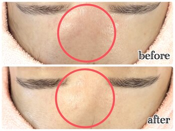 シルク(Cilk)/おでこの赤みが治まった！