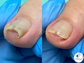 プラスワンフット 本厚木(+1 Foot)の写真/痛みを我慢しない。巻き爪/肥厚爪/魚の目/副爪/角質など足のトラブルに●フットケア専門店+1 Foot 本厚木へ