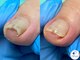 プラスワンフット 本厚木(+1 Foot)の写真/痛みを我慢しない。巻き爪/肥厚爪/魚の目/副爪/角質など足のトラブルに●フットケア専門店+1 Foot 本厚木へ