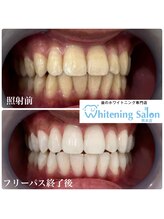 ホワイトニングサロン 熊本店/白い歯目指してホワイトニング