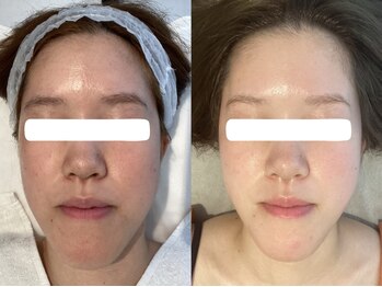 Nビューティー/最新RFサーモシェイプオーパス