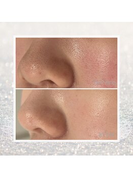 ディアー(Dear)/REVI 陶肌トリートメント