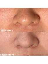 サロン ド エン(Salon de. en)/毛穴ケア◇ハーブピーリング