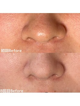 サロン ド エン(Salon de. en)/毛穴ケア◇ハーブピーリング