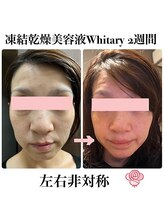 ケンビラク(Kenbiraku 健美楽)/顔の左右差　2週間