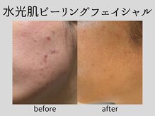 マーベル(MaaBelle)/水光肌ピーリング