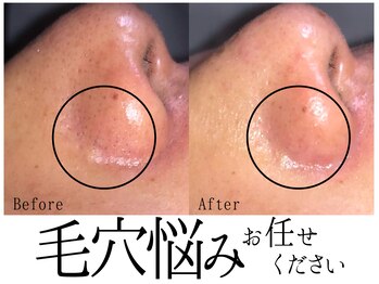 スポット 薬院駅前店(SPOT)/男女の毛穴肌悩みお任せください