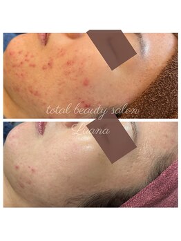 ルアナ 柏本店(LUANA)/ニキビ/毛穴/赤み/改善例
