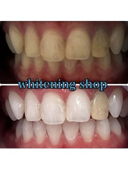 ホワイトニングショップ 池田店/【BEFORE/AFTER】