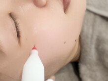 シミケア専門店 SAKURA 平塚店/30代のお客様シミケア40分広範囲