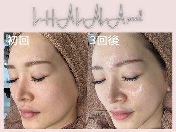 美シェリ(美Cheri)/ララピールビフォーアフター