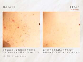 メレ(mele)/20代背中ケア/ニキビケア・毛穴