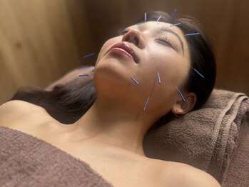 銀座 ボディハウス(BODY HOUSE)/美容鍼でフェイスアップ