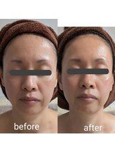 リルーチェ 倉敷(Riluce)/ダイヤモンドピーリング1回施術