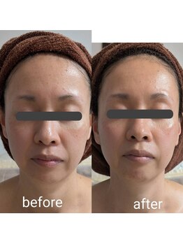 リルーチェ 倉敷(Riluce)/ダイヤモンドピーリング1回施術