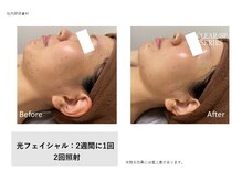 ミモザ(mimosa)の雰囲気（シミやニキビ等のお悩みに1回の効果が高いマシンで光照射します）