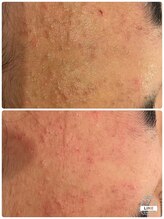 エステサロン クブ(Kubu)/思春期のニキビケア